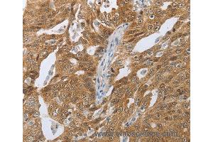 Immunohistochemistry of Human ovarian cancer using CEBPA Polyclonal Antibody at dilution of 1:40 (CEBPA anticorps)