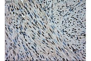 Immunohistochemical staining of paraffin-embedded Adenocarcinoma of colon tissue using anti-MAPK1mouse monoclonal antibody. (ERK2 anticorps)