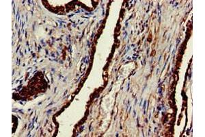 Immunohistochemistry of paraffin-embedded human prostate cancer using ABIN7147854 at dilution of 1:100