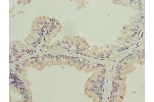 Immunohistochemistry of paraffin-embedded human prostate cancer using ABIN7157054 at dilution of 1:100