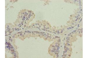 Immunohistochemistry of paraffin-embedded human prostate cancer using ABIN7157054 at dilution of 1:100 (ISCA2 anticorps  (AA 9-154))