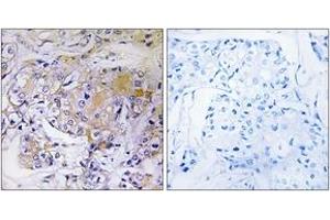 Immunohistochemistry analysis of paraffin-embedded human breast carcinoma tissue, using ULK3 Antibody. (ULK3 anticorps  (AA 141-190))