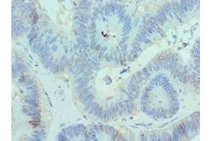 Immunohistochemistry of paraffin-embedded human colon cancer using ABIN7147709 at dilution of 1:100