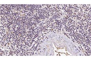 ABIN6273050 at 1/100 staining Human lymph cancer tissue by IHC-P. (IFT52 anticorps  (Internal Region))