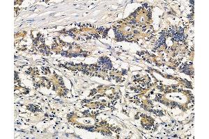 ABIN7096110 and ABIN7100172 at 1/100 staining human colorectal cancer by IHC-P.
