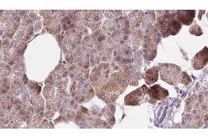 ABIN6273269 at 1/100 staining Human pancreas cancer tissue by IHC-P. (MTHFD1L anticorps  (C-Term))