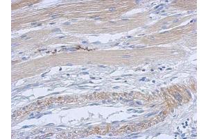 IHC-P Image Immunohistochemical analysis of paraffin-embedded human gastric cancer, using CDK4, antibody at 1:500 dilution.