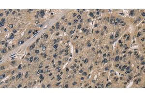 Immunohistochemistry of paraffin-embedded Human liver cancer tissue using CCAR1 Polyclonal Antibody at dilution 1:40 (CCAR1 anticorps)