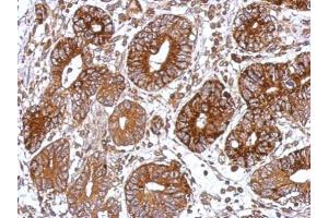 IHC-P Image Immunohistochemical analysis of paraffin-embedded human colon carcinoma, using GNAS, antibody at 1:500 dilution.
