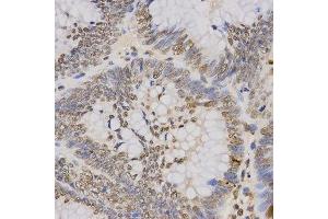 Immunohistochemistry of paraffin-embedded human rectal cancer using TriMethyl-Histone H3-K79 antibody. (Histone 3 anticorps  (H3K79me3))
