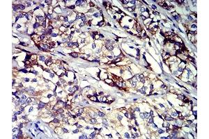 Immunohistochemical analysis of paraffin-embedded bladder cancer tissues using CD61 mouse mAb with DAB staining. (Integrin beta 3 anticorps  (AA 27-179))