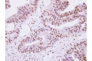 IHC-P Image Selenophosphate synthetase 1 antibody detects SEPHS1 protein at nucleus on human colon carcinoma by immunohistochemical analysis. (SEPHS1 anticorps)