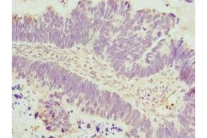 Immunohistochemistry of paraffin-embedded human ovarian cancer using ABIN7150033 at dilution of 1:100 (DAAM2 anticorps  (AA 1-86))
