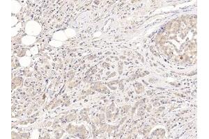 Detection of GPC3 in Human Breast cancer Tissue using Polyclonal Antibody to Glypican 3 (GPC3)