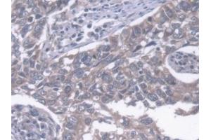 Detection of ERLIN2 in Human Lung cancer Tissue using Polyclonal Antibody to Endoplasmic Reticulum Lipid Raft Associated Protein 2 (ERLIN2) (ERLIN2 anticorps  (AA 47-339))