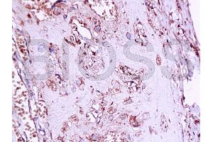 Formalin-fixed and paraffin embedded human placenta tissue labeledwith Anti-Phospho-Estrogen Receptor alpha (Ser167) Polyclonal Antibody, Unconjugated (ABIN729493) at 1:200, followed by conjugation to the secondary antibody and DAB staining (Estrogen Receptor alpha anticorps  (pSer167))