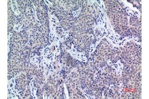 Immunohistochemistry (IHC) analysis of paraffin-embedded Human Mammary Cancer, antibody was diluted at 1:100.