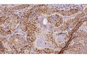 ABIN6267088 at 1/100 staining Human thyroid cancer tissue by IHC-P. (CDC25B anticorps  (pSer151))