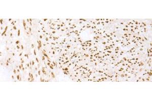 Immunohistochemistry of paraffin-embedded Human liver cancer tissue using TCOF1 Polyclonal Antibody at dilution of 1:50(x200) (TCOF1 anticorps)