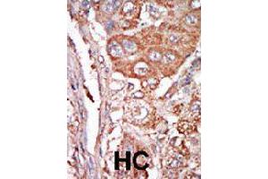 Formalin-fixed and paraffin-embedded human hepatocellular carcinoma tissue reacted with FGF4 polyclonal antibody  , which was peroxidase-conjugated to the secondary antibody, followed by DAB staining. (FGF4 anticorps  (C-Term))