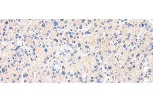 Immunohistochemistry of paraffin-embedded Human liver cancer tissue using MUC7 Polyclonal Antibody at dilution 1:30 (MUC7 anticorps)