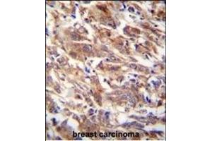 FBXW12 Antibody (C-term) (ABIN654226 and ABIN2844060) immunohistochemistry analysis in formalin fixed and paraffin embedded human breast carcinoma followed by peroxidase conjugation of the secondary antibody and DAB staining.