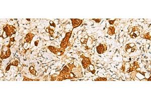 Immunohistochemistry of paraffin-embedded Human liver cancer tissue using C11orf54 Polyclonal Antibody at dilution of 1:50(x200) (C11orf54 anticorps)
