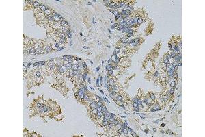 Immunohistochemistry of paraffin-embedded Human prostate using PSAT1 Polyclonal Antibody at dilution of 1:100 (40x lens). (PSAT1 anticorps)