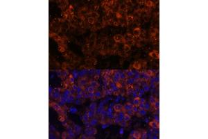 Immunofluorescence analysis of human liver cancer using PAI-1/Serpin E1 Polyclonal Antibody (ABIN6131330, ABIN6147601, ABIN6147603 and ABIN6221802) at dilution of 1:100 (40x lens). (PAI1 anticorps  (AA 24-402))