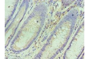 Immunohistochemistry of paraffin-embedded human colon cancer using ABIN7156763 at dilution of 1:100 (IL1RN anticorps  (AA 22-230))