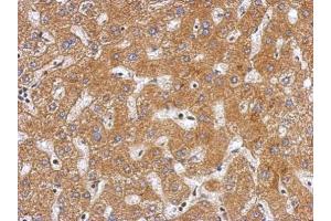 IHC-P Image Immunohistochemical analysis of paraffin-embedded human hepatoma, using Plasminogen, antibody at 1:500 dilution.