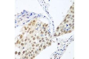 Immunohistochemistry of paraffin-embedded human lung cancer using BCAS2 antibody.