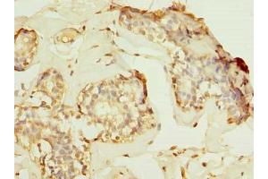 Immunohistochemistry of paraffin-embedded human breast cancer using ABIN7155221 at dilution of 1:100 (HPCAL1 anticorps  (AA 2-193))
