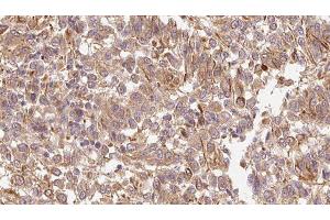 ABIN6278314 at 1/100 staining Human Melanoma tissue by IHC-P. (LEFTY2 anticorps  (Internal Region))