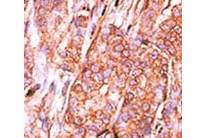 IHC analysis of FFPE human breast carcinoma tissue stained with the CTDSP2 antibody