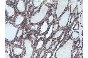 Immunohistochemical staining of paraffin-embedded Carcinoma of Human thyroid tissue using anti-C20orf3 mouse monoclonal antibody. (APMAP anticorps)