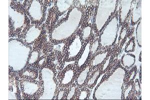 Immunohistochemical staining of paraffin-embedded Carcinoma of Human thyroid tissue using anti-C20orf3 mouse monoclonal antibody.
