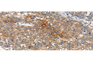 Immunohistochemistry of paraffin-embedded Human liver cancer tissue using B4GAT1 Polyclonal Antibody at dilution of 1:110(x200)