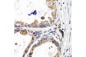 Immunohistochemistry of paraffin-embedded human stomach cancer using F antibody (ABIN6129515, ABIN6140420, ABIN6140421 and ABIN6220936) at dilution of 1:200 (40x lens). (FABP3 anticorps  (AA 1-133))