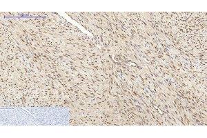 Immunohistochemistry of paraffin-embedded Human uterus cancer tissue using HSP70 Monoclonal Antibody at dilution of 1:200.