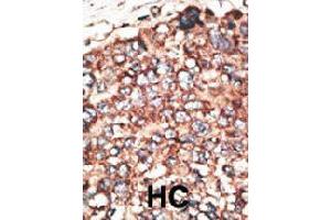 Formalin-fixed and paraffin-embedded human hepatocellular carcinoma tissue reacted with MMP17 polyclonal antibody  , which was peroxidase-conjugated to the secondary antibody, followed by DAB staining. (MMP17 anticorps  (Internal Region))