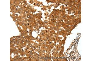 Immunohistochemistry of Human thyroid cancer using SSTR1 Polyclonal Antibody at dilution of 1:50 (SSTR1 anticorps)