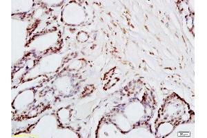 Formalin-fixed and paraffin embedded human colon carcinoma tissue labeled with Anti-FRA2/FOSL2 Polyclonal Antibody, Unconjugated  at 1:200 followed by conjugation to the secondary antibody and DAB staining (FOSL2 anticorps  (AA 231-326))