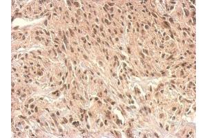 IHC-P Image Monoglyceride lipase antibody detects MGLL protein at nucleus on U373 xenograft by immunohistochemical analysis. (MGLL anticorps)