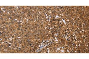 Immunohistochemistry of paraffin-embedded Human cervical cancer using FKBP8 Polyclonal Antibody at dilution of 1:50 (FKBP8 anticorps)