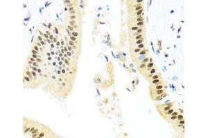 Immunohistochemistry of paraffin-embedded Human liver damage using ZBTB17 Polyclonal Antibody at dilution of 1:100 (40x lens). (ZBTB17 anticorps)