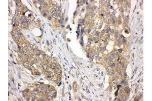 IHC-P: LASP1 antibody testing of human lung cancer tissue