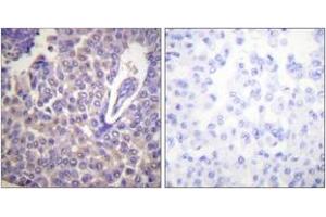 Immunohistochemistry analysis of paraffin-embedded human breast carcinoma, using Calnexin (Phospho-Ser583) Antibody. (Calnexin anticorps  (pSer583))