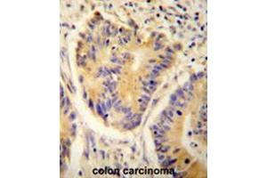 ADH4 antibody(C-term) immunohistochemistry analysis in formalin fixed and paraffin embedded human colon carcinoma followed by peroxidase conjugation of the secondary antibody and DAB staining. (ADH4 anticorps  (C-Term))