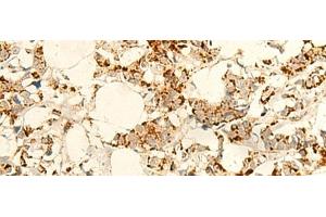 Immunohistochemistry of paraffin-embedded Human breast cancer tissue using NAPRT Polyclonal Antibody at dilution of 1:50(x200)